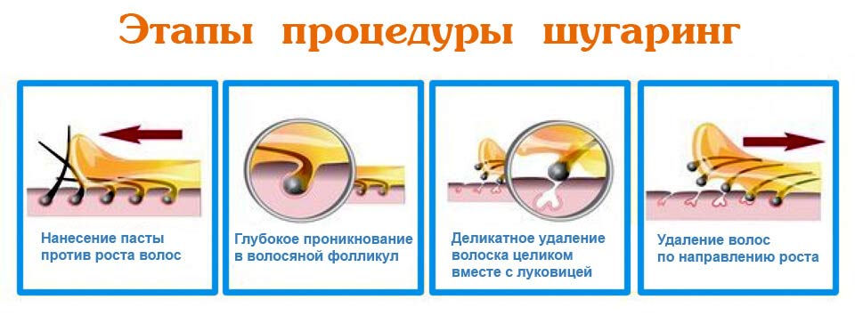 этапы поцедуры шугаринг