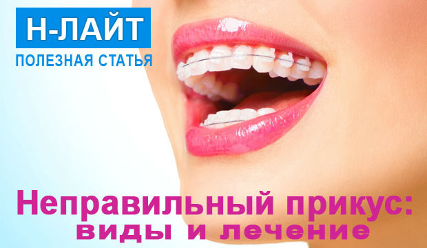 Неправильный прикус – виды и лечение
