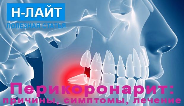 Перикоронарит – причины, симптомы, лечение