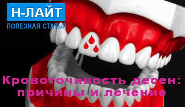 Причины и лечение кровоточивости десен