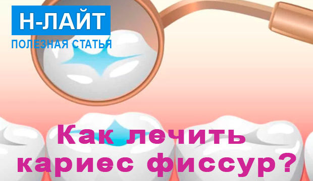 Кариес фиссур – как лечить