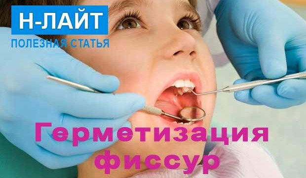Герметизация фиссур как профилактика кариеса у детей