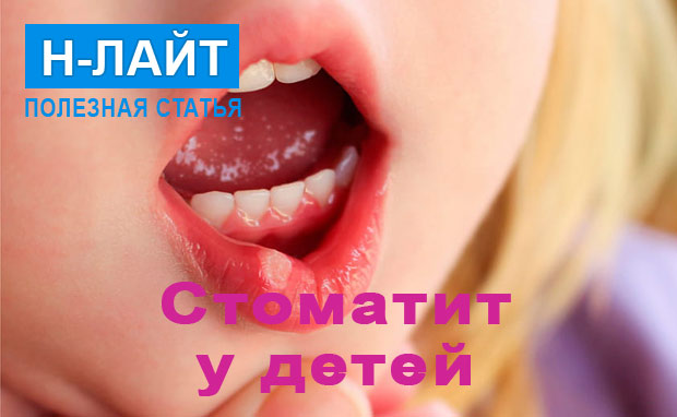 Острые стоматиты у детей