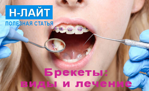 Брекеты: виды и лечение