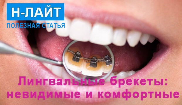 Лингвальные брекеты – невидимые и комфортные