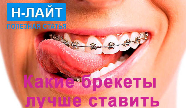 Какие брекеты лучше ставить