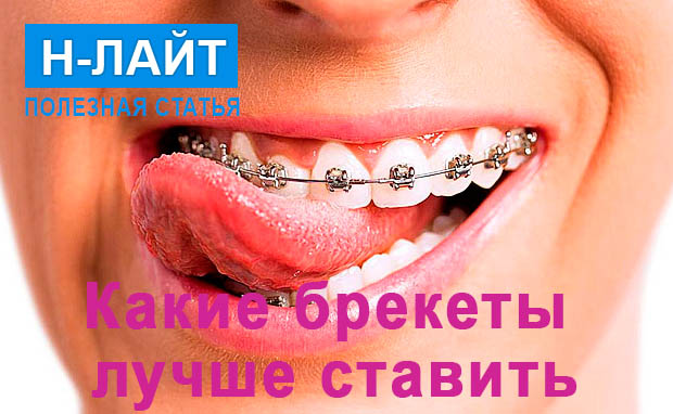Какие брекеты лучше ставить