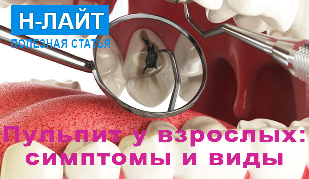 Пульпит зуба у взрослых — симптомы и виды